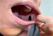 A buccal patch stuck to the inside of the mouth might deliver drugs more quickly and with fewer side effects.